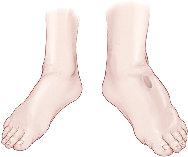 Varicose veins laser surgery- Jaju Clinic 
